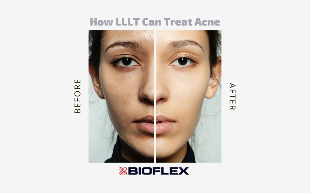 Low-Level Laser Therapy (LLLT) to treat acne