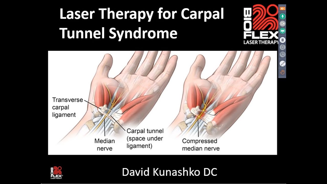 Laser Therapy For Carpal Tunnel Syndrome web